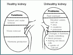 kidney-failure